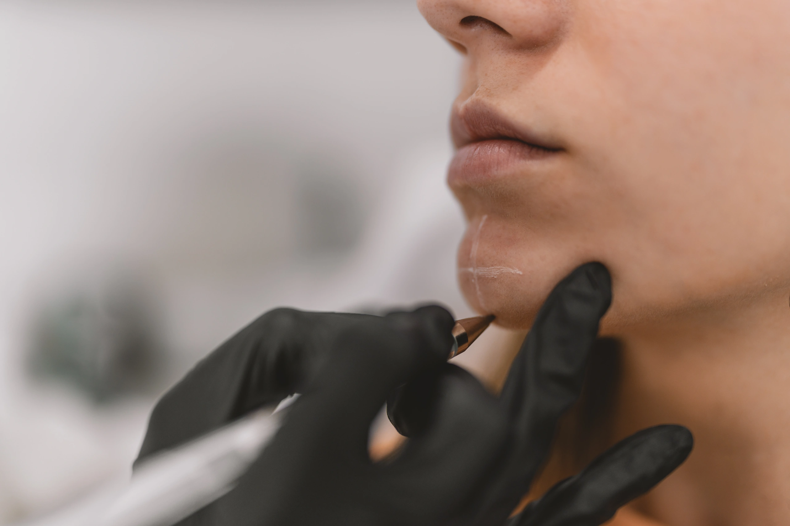 Profissional de biomedicina estética realizando marcação facial no queixo de uma paciente